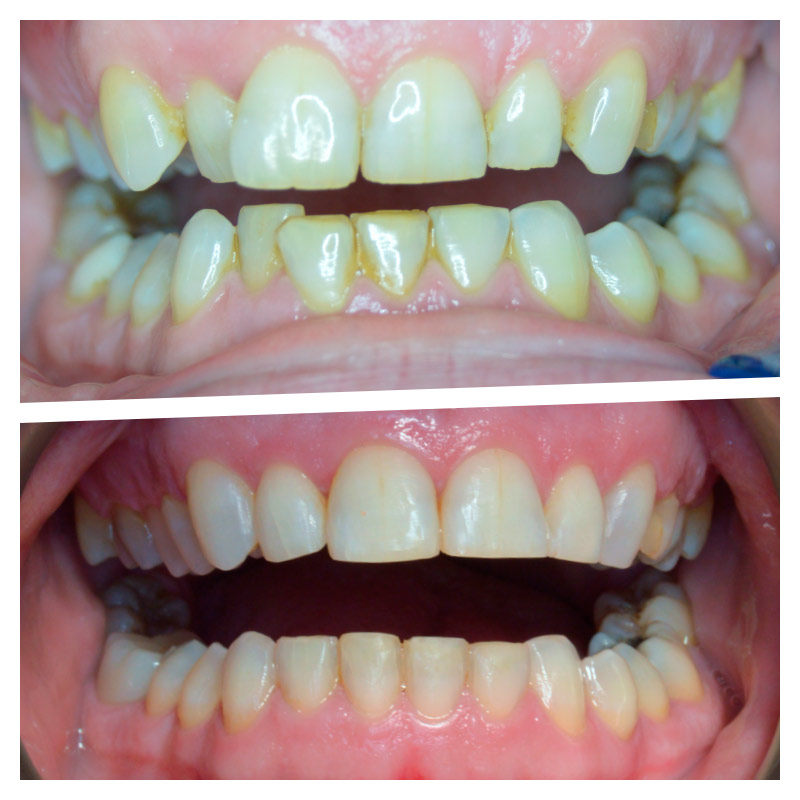 White Straight Teeth - Bannockburn Dental Care